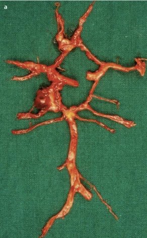 Amazing view of a real Circle of Willis! See the problem?