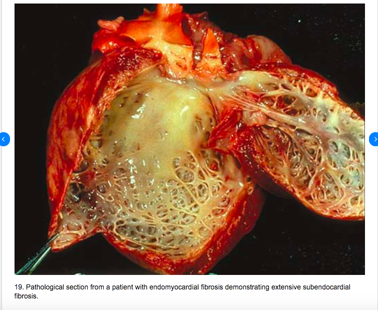 New study shows that Covid causes heart damage that may lead to  'sudden cardiac death'

Findings might 'have critical long‐term public health implications for health care systems and policy makers'