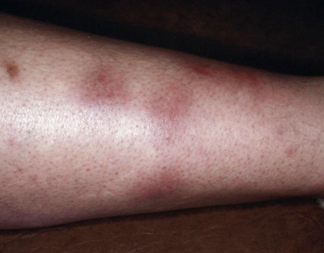 DraCaroQuintero's tweet photo. Eritema nosodo: Nódulos de 2 a 5 cm fijos, eritematosos, dolorosos en la región anterior de las piernas (reacción de hipersensibilidad IV) Imagen: UpToDate. https://t.co/rzhxeoid6J