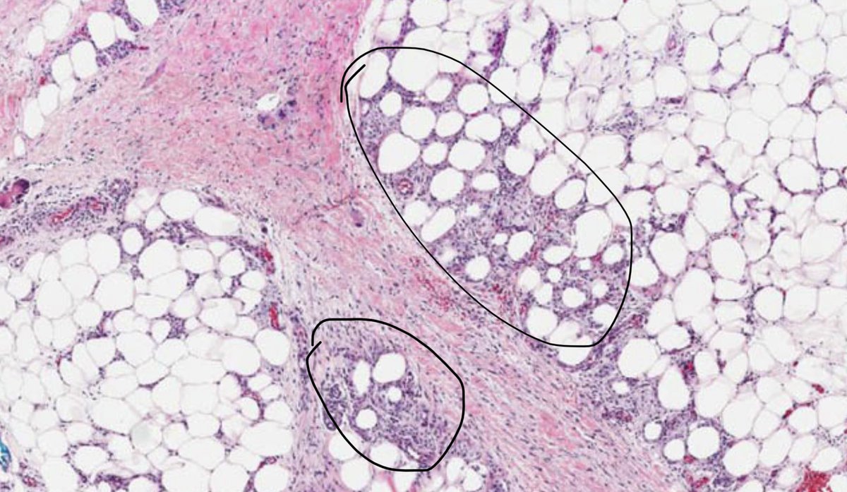 DraCaroQuintero's tweet photo. Aunque la etiología del eritema nodoso es diversa hasta el 37% de los casos son idiopáticos. La histologia típica es una paniculitis septal SIN vasculitis ✏️ https://t.co/UVDuikQHap