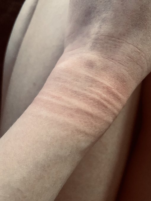 OK Google, please tell me how to get rid of rope burn in ten seconds or less, I have company at my house<a href="/tag/fuckcovid"class="tags"><span>#fuckcovid</span></a>