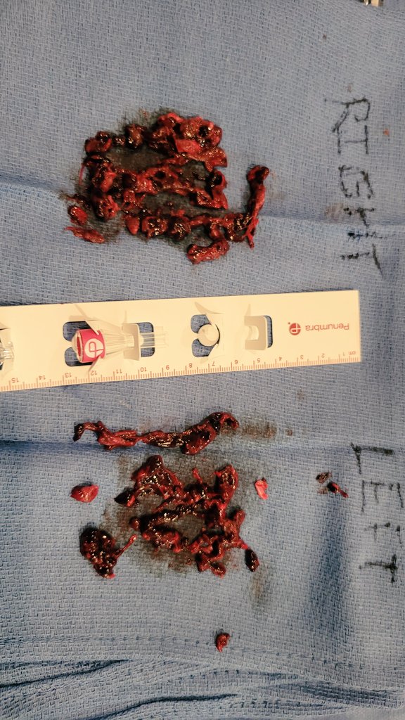 mamillyA's tweet photo. Two cases of PE mechanical thrombectomy using the new Penumbra Lighting Flash catheter. Awesome results 👏 https://t.co/OlfTvdlQ6f