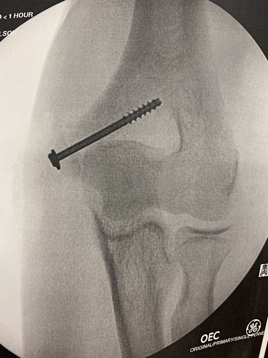 Went into surgery yesterday. Can't wait to be back on the mound and stronger than ever. 3 months and counting. <a href="/RecruitMETx/">METx Recruiting</a> <a href="/CyFairBaseball/">Cy-Fair Bobcats Baseball</a>