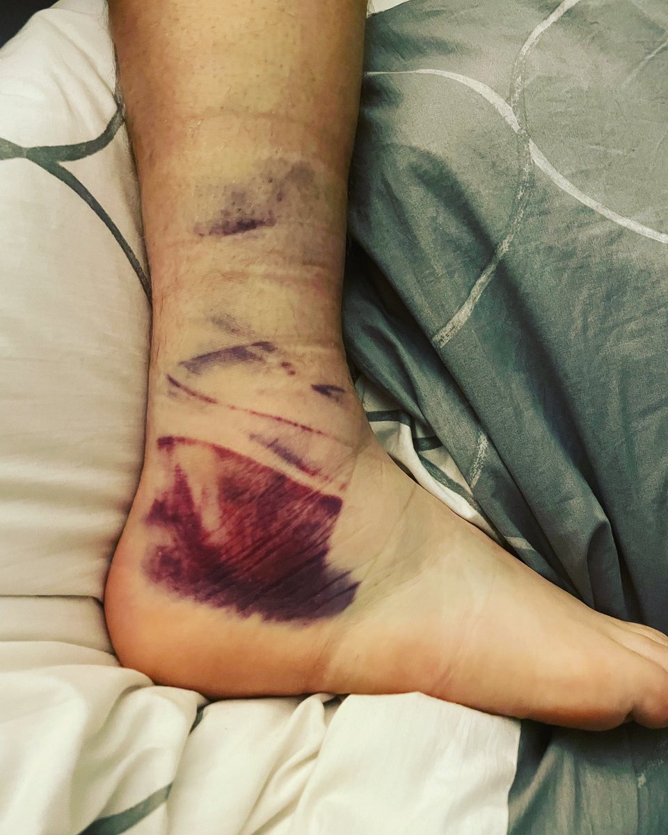 Elite16ST's tweet photo. Some wonderfully coloured bruising arising from a lateral ankle sprain! X-ray cleared, time to get the ice on and rehab started! https://t.co/YcMbHUlPBf