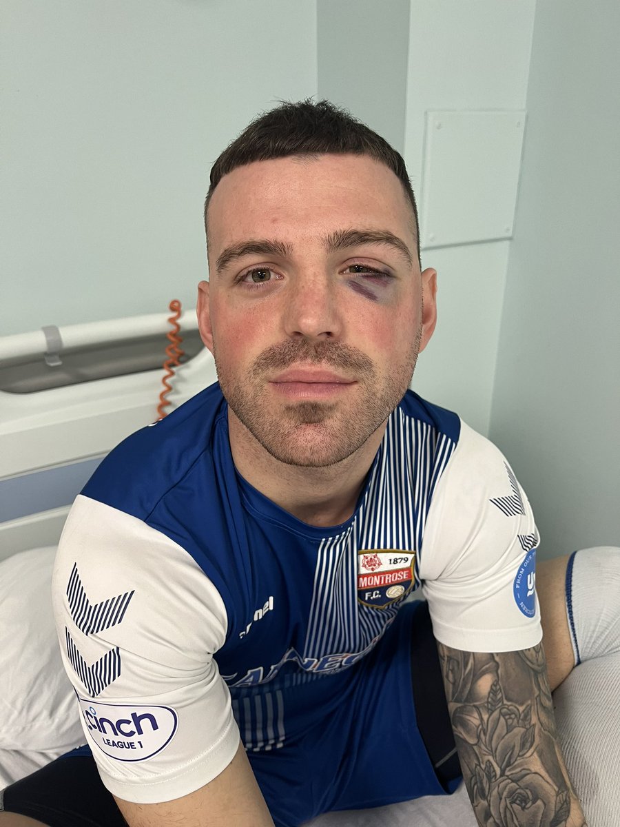 Waddell_Kerr's tweet photo. Fair knee to the face today. Broken cheekbone and eye socket. Least the last minute goal made me a feel a bit better. 🤮💙 @MontroseFC https://t.co/urAbZLsVU0