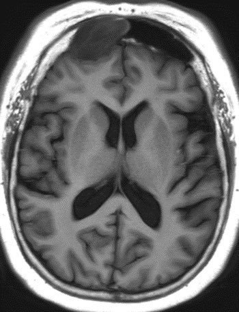 Medical Clinical Case On Twitter Rt Daniel Gewolb Paranasal Sinus