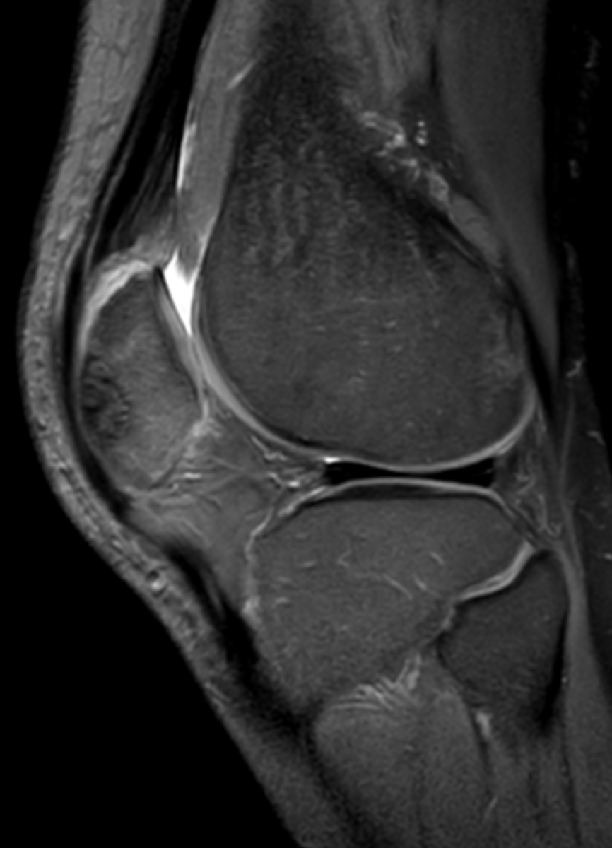 mskteachingroom's tweet photo. MR images as promised 👇

What do you think of the quadriceps tendon?🤔

#radfellow #radiologyresident #learningradiology #radres #mskrad #radtwitter #radiology #transformingradiology #MRI https://t.co/0DsnoMi706