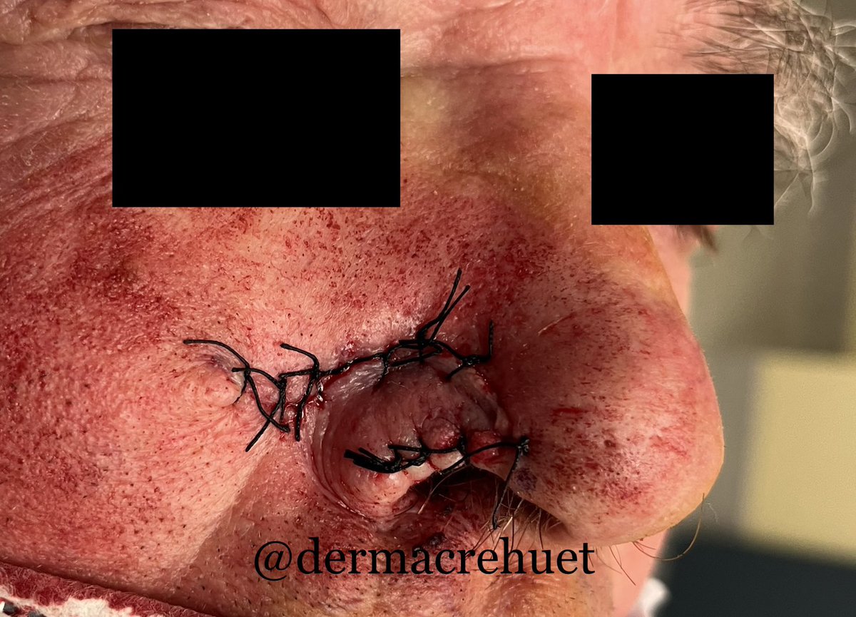 #surgery #BasalCellCarcinoma #removal #nose shark #flap #oncology #dermatology #skincancer #rotationflap what do u think?