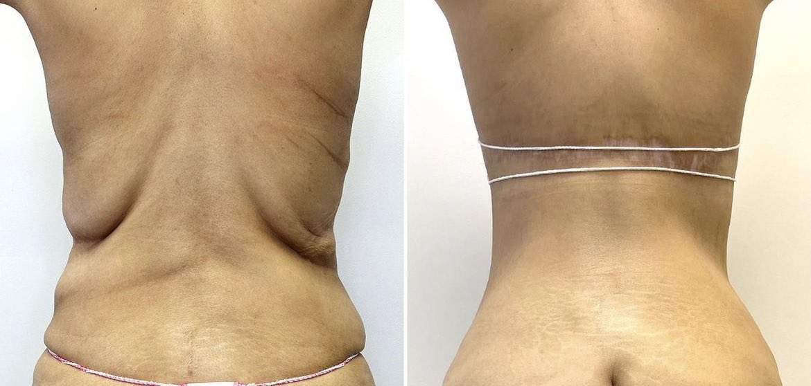 The Cosmetic Lane on X: Back lift ✨ This patient had lost a massive amount  of weight and was left with loose skin all over her body, including her back.   /