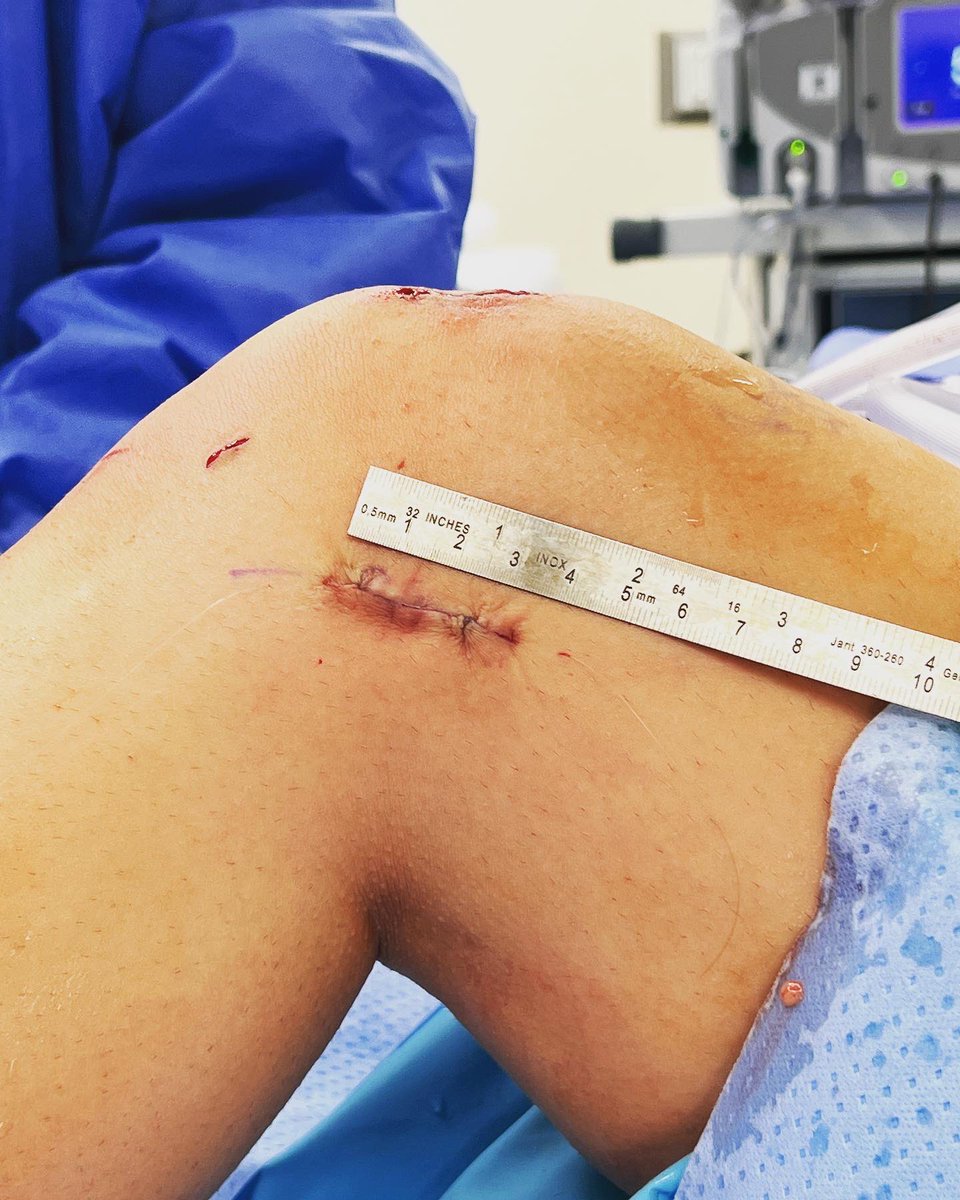 JustinJMitchell's tweet photo. More and more data suggests that adding a lateral extra-articular Tenodesis to our ACL reconstruction procedures improves failure rates and functional outcomes - especially in our highest risk patient populations. https://t.co/WpoKdavYR7