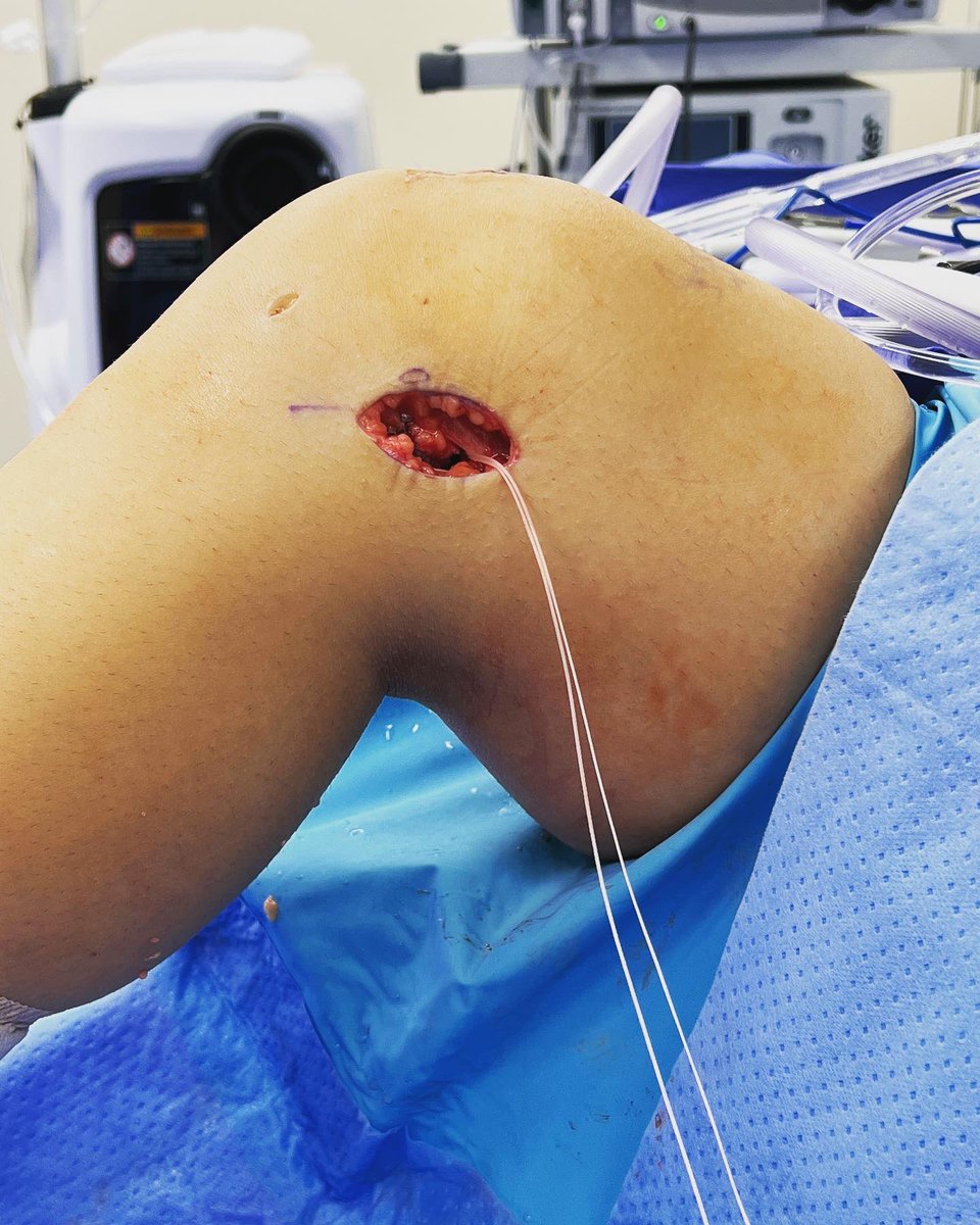 JustinJMitchell's tweet photo. More and more data suggests that adding a lateral extra-articular Tenodesis to our ACL reconstruction procedures improves failure rates and functional outcomes - especially in our highest risk patient populations. https://t.co/WpoKdavYR7
