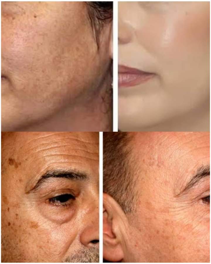 #الحياه_الزوجيه
عندك كلف او نمش او تصبغات في وجهك او جسمك راسلني خاص حلك عندنا 🚫