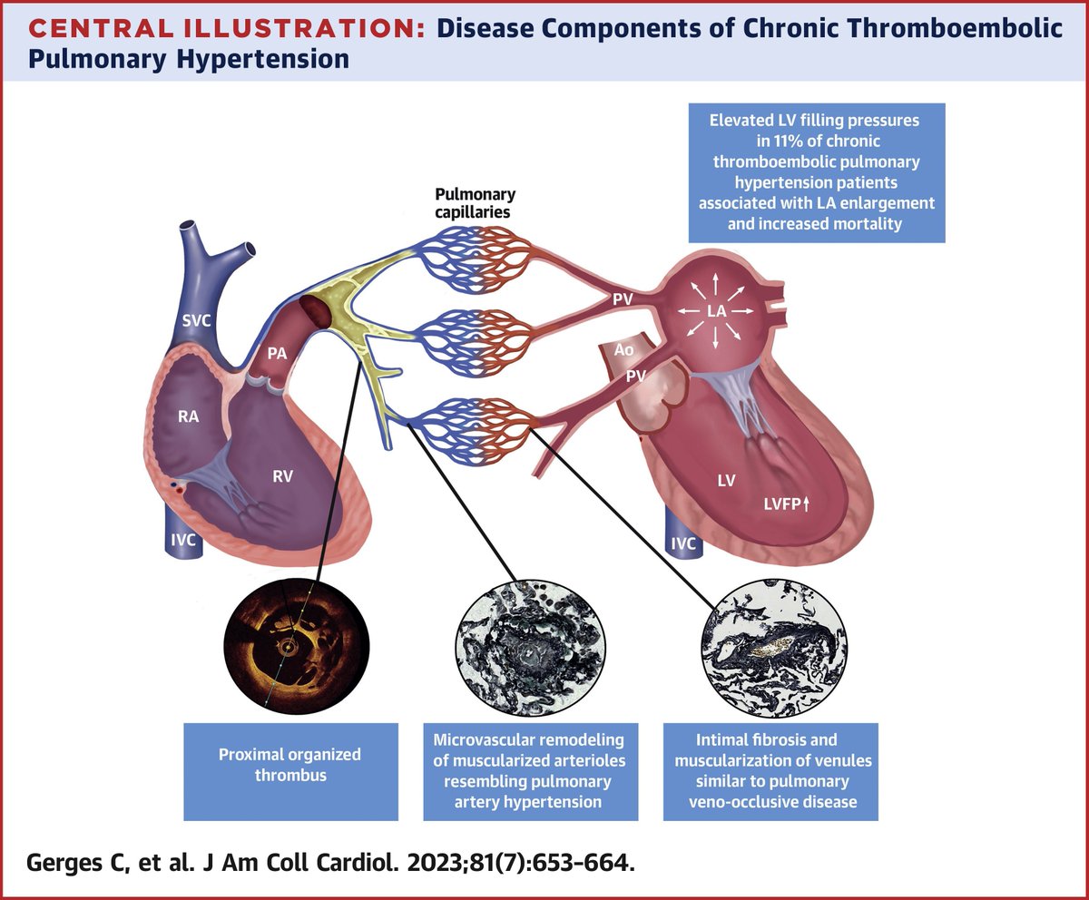 JACC Journals (@jaccjournals) on Twitter photo How are LV filling pressures affected by #CTEPH? How does this affect patient outcomes?
In this insightful work, Drs. <a href="/ChristianGerges/">Christian Gerges</a>, Lang, & colleagues evaluate this question w/ important implications for #CardioTwttier & #PulmTwitter providers: bit.ly/3YXtTmn #JACC How are LV filling pressures affected by #CTEPH? How does this affect patient outcomes?
In this insightful work, Drs. <a href="/ChristianGerges/">Christian Gerges</a>, Lang, & colleagues evaluate this question w/ important implications for #CardioTwttier & #PulmTwitter providers: bit.ly/3YXtTmn #JACC