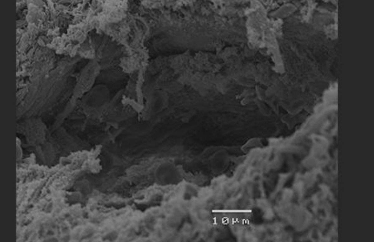 Patrick Starlinger_TELL International (@tell_starlinger) on Twitter photo Remember your last time after a right trisec the liver tissue appears swollen and almost felt congested? - ever were interested what is happening at that time right there in the tissue? - we looked at that just now jhep-reports.eu/article/S2589-… inflammation is key - again 🧐… <a href="/aahpbs/">Austrian Association of HPB Surgery</a> Remember your last time after a right trisec the liver tissue appears swollen and almost felt congested? - ever were interested what is happening at that time right there in the tissue? - we looked at that just now jhep-reports.eu/article/S2589-… inflammation is key - again 🧐… <a href="/aahpbs/">Austrian Association of HPB Surgery</a>