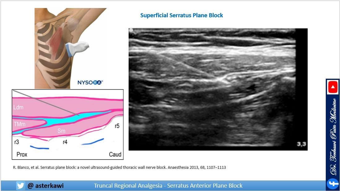 asterkawi's tweet image. Serratus Anterior Plane Block: youtu.be/5UAtyigWU84 

Potentially blocks the lateral cutaneous branches of the intercostal nerves from T2 to T7-9, depend on the position and volume of LA, intercostobrachial nerve, long thoracic nerve, and thoracodorsal nerve.