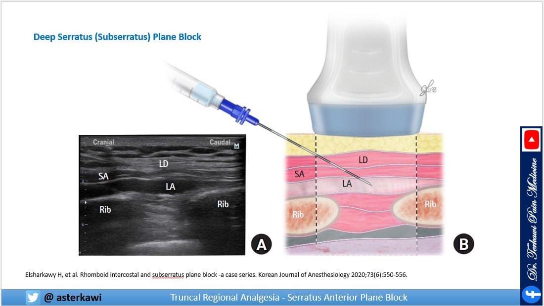 asterkawi's tweet image. Serratus Anterior Plane Block: youtu.be/5UAtyigWU84 

Potentially blocks the lateral cutaneous branches of the intercostal nerves from T2 to T7-9, depend on the position and volume of LA, intercostobrachial nerve, long thoracic nerve, and thoracodorsal nerve.