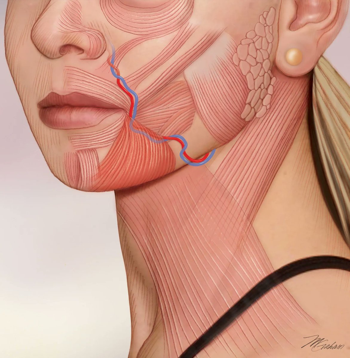 Medillustrates's tweet photo. "Facial artery and vein" illustration by Michele Graham.
Explore more: https://t.co/MIcNQ2lzVI
#medical #illustration #medicalillustration #facialanatomy #anatomy #vascularsurgery #plasticsurgery #facialmuscles #anatomicalillustration #sciart #medicalillustrator https://t.co/swYgH1osmD