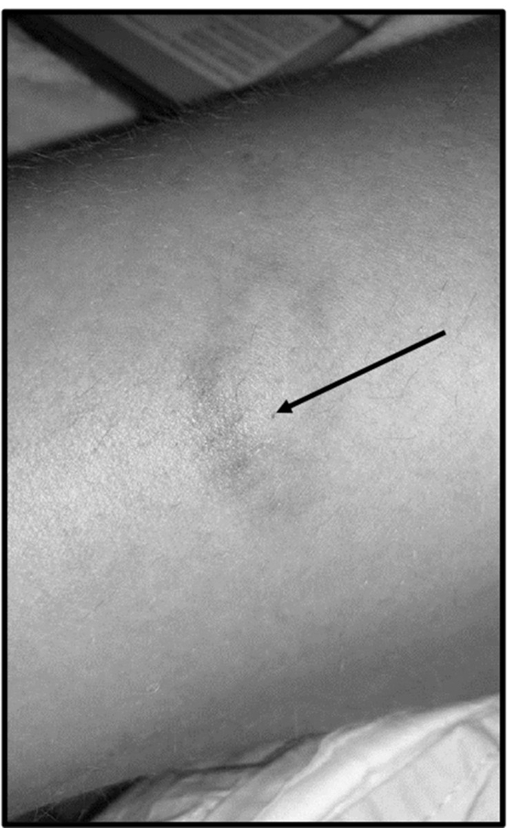 #PracticeReview #Feb2023

Drink and injection spiking: how to approach an increase in presentations?

With increasing presenatations of this, the #PracticeReview discuss options on how to approach this. 

<a href="/TessBlandamer/">tess blandamer</a> @EddCarlton  <a href="/DrTomRoberts/">Tom Roberts</a> 

emj.bmj.com/content/early/…