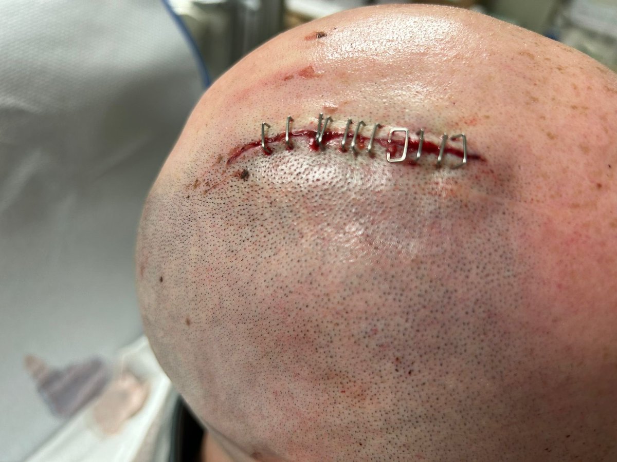 Sunday football is suppose to be enjoyable. One of your players shouldn’t need to have to go hospital to get 11 staples in his head after a player on the oppositions team has ran 40 yards to 2 foot him in the head while he is already on the floor after being punched.