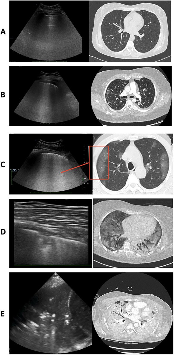 Lung #POCUS findings correlated to chest CT progressing from normal aeration (A), to progressively more deaerated conditions: coalescent B-lines (B and C), small peripheral consolidation (D), large consolidation (E). The red box in (C) shows an area of ncbi.nlm.nih.gov/pmc/articles/P…
