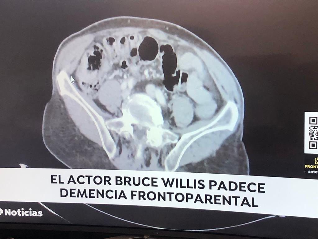 3DSeoane's tweet photo. @A3Noticias pofavó revisad el rigor científico!🚨🤦🏻‍♂️Se dice fronto-parietal, parental pues haría referencia a sus padres. Y en la segunda foto se repite el error y la imagen difundida es un intestino en el abdomen! No un cerebro…Siendo del campo, sangran bastante los 👁️👁️ https://t.co/Ve2lqdCmSW