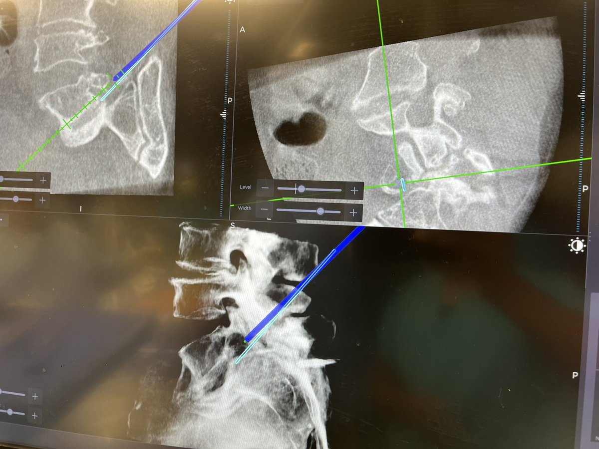 Who says you need a “special” system to merge navigation with transforaminal spinal endoscopy?

Navigated jamsheedi + SureTrak for reamers/endoscope @TJUHospital. Autofused grade 2 L5-S1 spondy. @Medtronic + #Joimax

Great work by @TJUHNeurosurg resident Evan Fitchett! @ForSpine