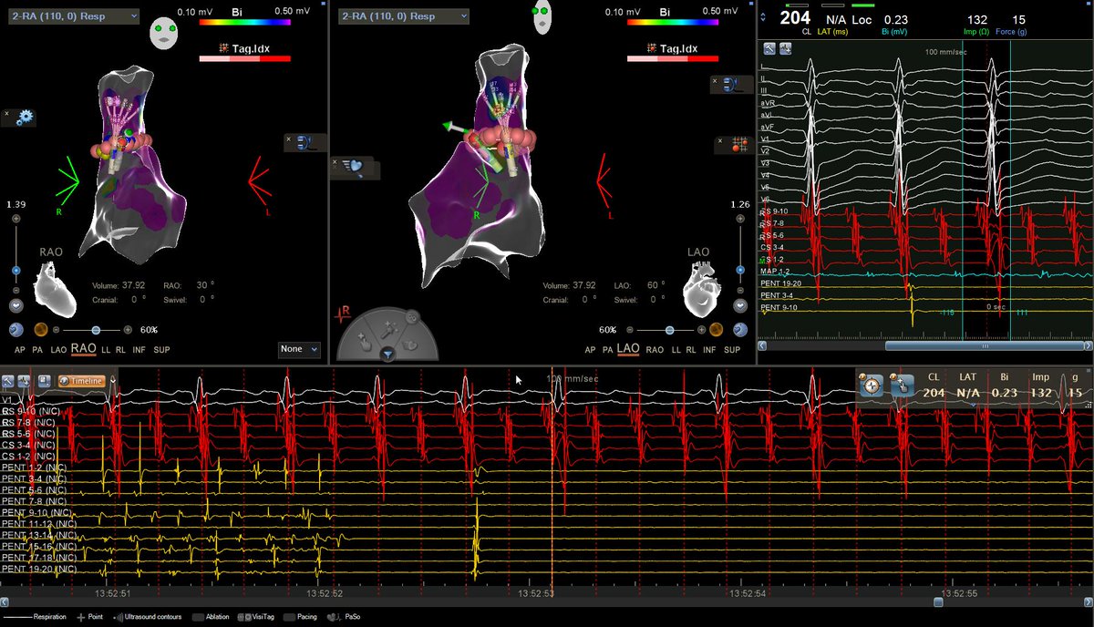 jerryccw2703's tweet photo. SVC triggered AFib:
-> SVC Isolation.
-> AFib self-terminated.
-> SVC potential exit block.
#afib
#svc
#NonPV
#EPeeps https://t.co/HIDjIr3XZs