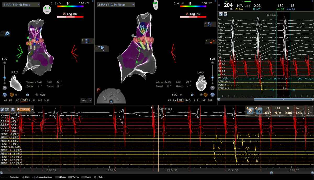 jerryccw2703's tweet photo. SVC triggered AFib:
-> SVC Isolation.
-> AFib self-terminated.
-> SVC potential exit block.
#afib
#svc
#NonPV
#EPeeps https://t.co/HIDjIr3XZs