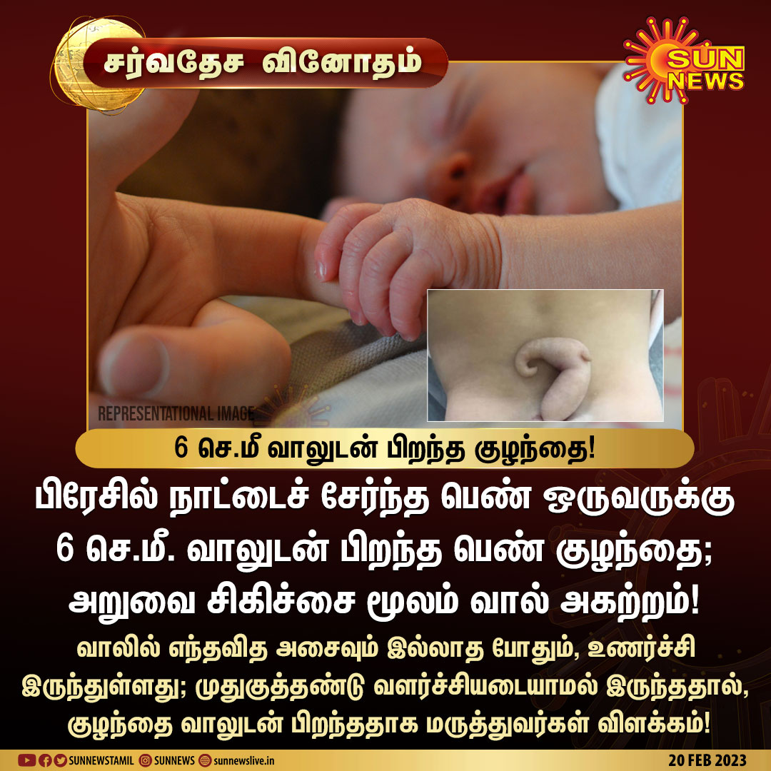 sunnewstamil's tweet photo. #சர்வதேசவினோதம் | 6 செ.மீ வாலுடன் பிறந்த குழந்தை!
#SunNews | #Brazil | #Tailbone https://t.co/VOm6oGARfu