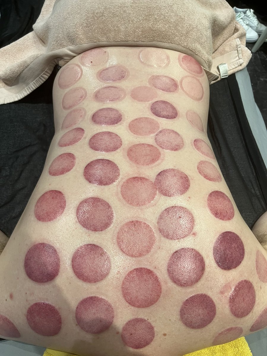 LC0380's tweet photo. Not many can say they love their job but I love mine, helping people feel better and get their mobility back is so rewarding #LifeAsAMassageTherapist #CuppingTherapy #LoveMyJob https://t.co/XU7eoog5Rg
