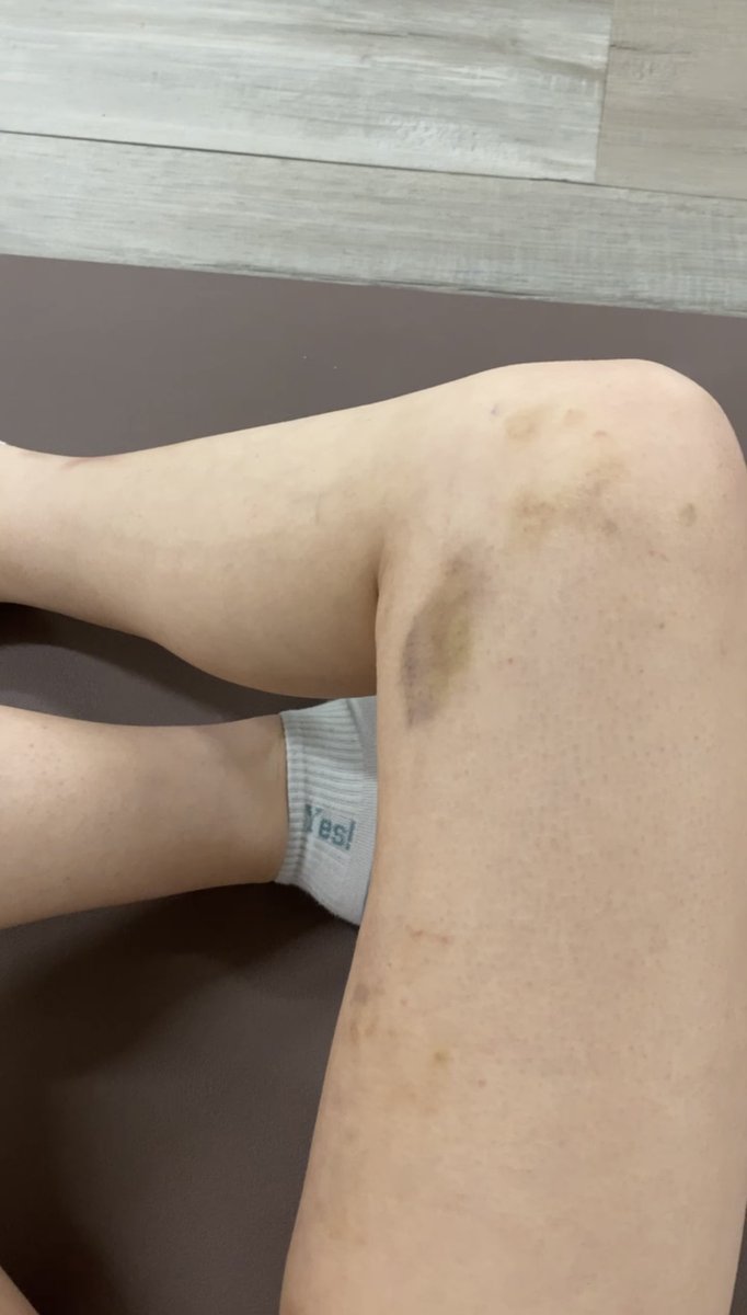 hhoiyau's tweet photo. The BTS of a pole dancer, but I would like to call them "pole kisses" :P
#MARK1051 #poledancing #poledancer #polebruises https://t.co/MvC3FOnVe4