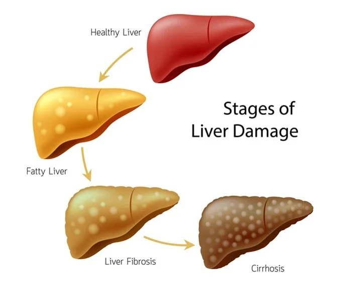 Women with irregular periods may be at risk for liver disease
#Health #news #today #Trending #Now #Women #periods