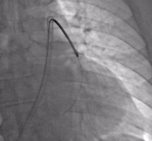 Ido Weinberg, MD (@angiologist) on Twitter photo Proud of <a href="/DocAsger/">Asger Andersen</a>, <a href="/AbudiTami/">Tami Abudi</a> and the Magneto team for this <a href="/JACCJournals/">JACC Journals</a> FIH report of Mechanical-Electric Thrombectomy in Acute Pulmonary Embolism!
jacc.org/doi/10.1016/j.…
<a href="/PERTConsortium/">The PERT Consortium®</a> <a href="/VladLakhter/">Vladimir Lakhter</a> #MedicalDevice Proud of <a href="/DocAsger/">Asger Andersen</a>, <a href="/AbudiTami/">Tami Abudi</a> and the Magneto team for this <a href="/JACCJournals/">JACC Journals</a> FIH report of Mechanical-Electric Thrombectomy in Acute Pulmonary Embolism!
jacc.org/doi/10.1016/j.…
<a href="/PERTConsortium/">The PERT Consortium®</a> <a href="/VladLakhter/">Vladimir Lakhter</a> #MedicalDevice