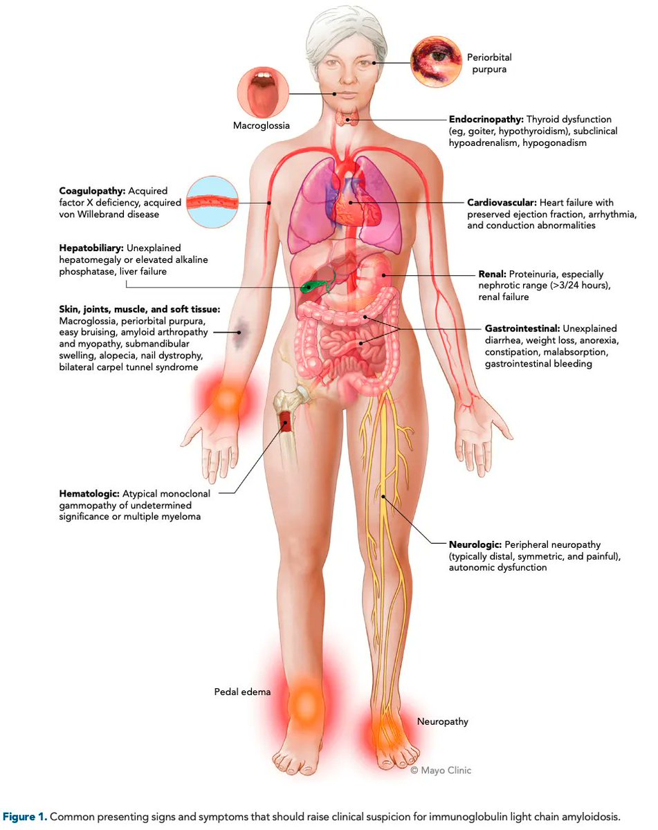 #Hematología #MedicinaInterna
Signos y síntomas comunes de la amiloidosis de cadena ligera de inmunoglobulina. 

J Natl Compr Canc Netw. 2023;21(1):83-90. doi:10.6004/jnccn.2022.7077