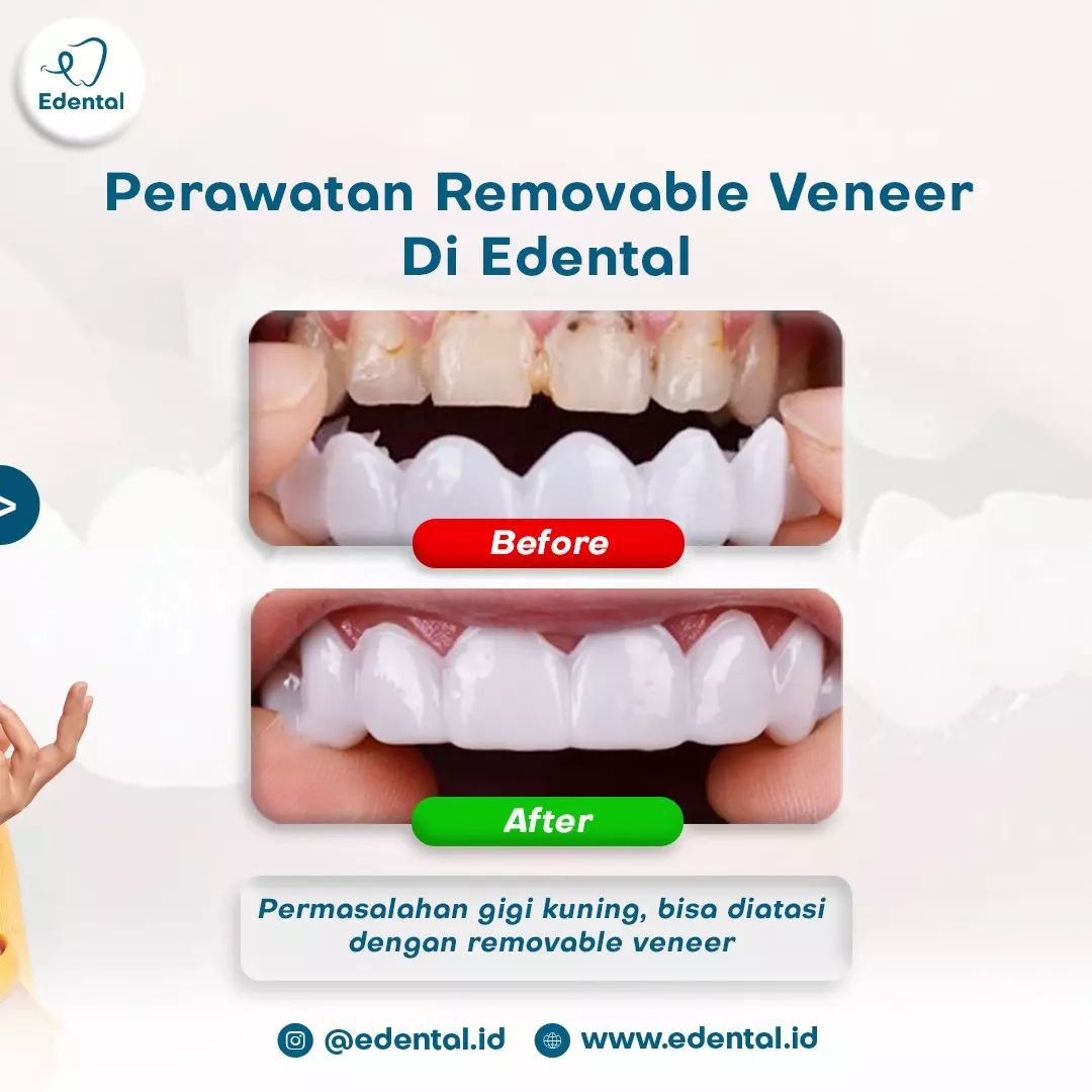 Edental001's tweet photo. Tuhkannnn kalo kayagini pasti jadi pede lagiii! Ya kannnn. Yukk kalo mau pasang removable venner bisa banget di Edental yaa guys! 🥰

#Trending #TrendingNow #removablevenner #behelgigi #quotes https://t.co/XSUNvOTcr4