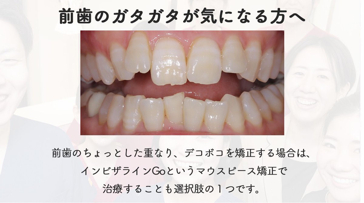 UmedaADC's tweet photo. 前歯だけ気になる方の🦷
マウスピース矯正😬 https://t.co/kIOKL3aTat