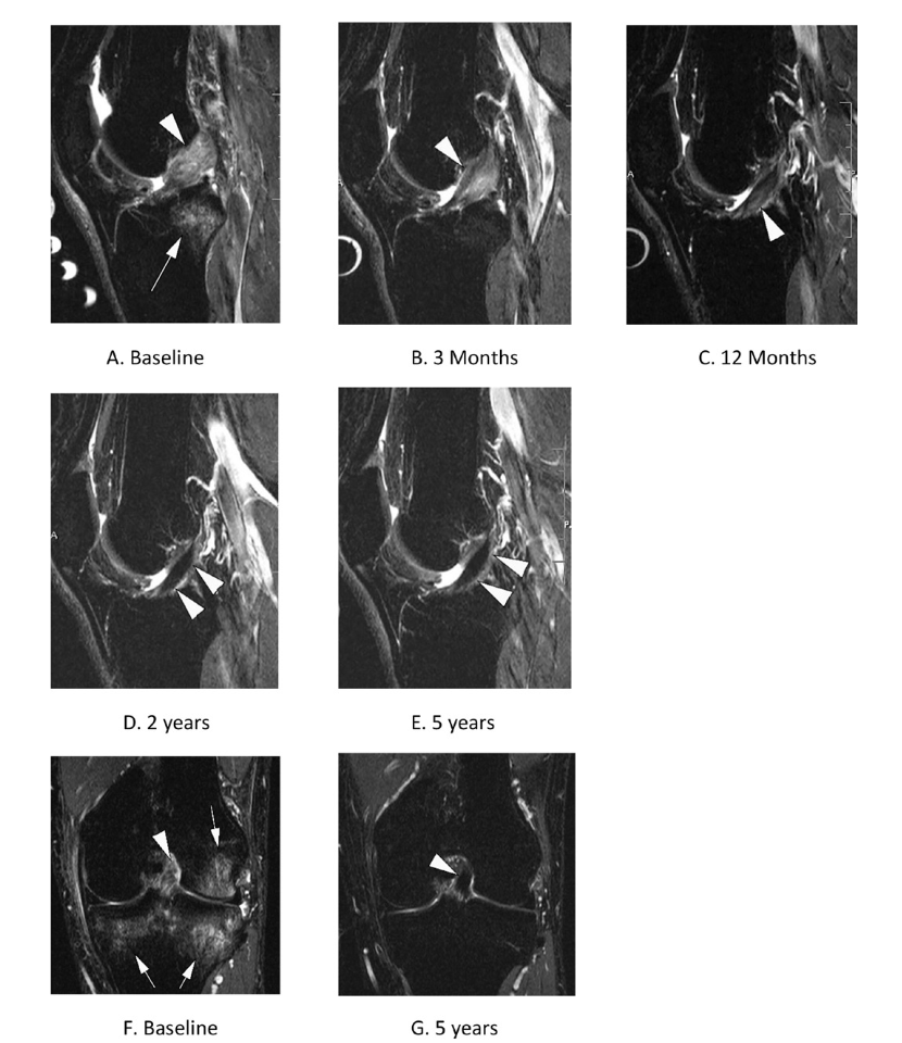 Elements_System's tweet photo. LIGAMENTO CRUZADO ANTERIOR. Confirmación de curaciones sin necesidad de operarse en 1 de cada 3 pacientes. ¿Nueva era de la rehabilitación de esta lesión? https://t.co/EcyO8lpgG8 https://t.co/xyct74xzMQ
