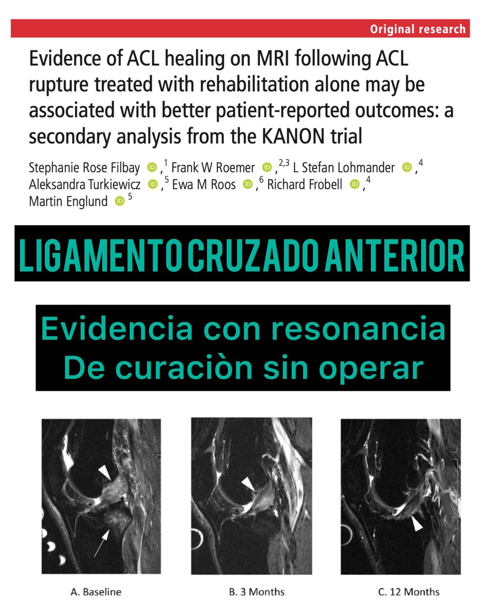 Elements_System's tweet photo. LIGAMENTO CRUZADO ANTERIOR. Confirmación de curaciones sin necesidad de operarse en 1 de cada 3 pacientes. ¿Nueva era de la rehabilitación de esta lesión? https://t.co/EcyO8lpgG8 https://t.co/xyct74xzMQ