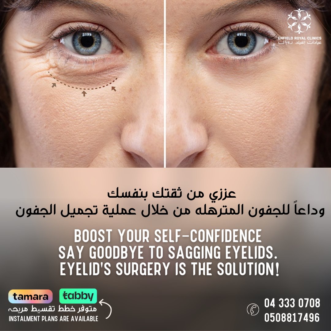 ClinicEnfield's tweet photo. جراحة تجميل الجفون مع الدكتور خوان كارلوس في عيادات انفيلد رويال , انت في أيادي أمينة
Eyelid surgery with Dr. Juan Carlos at the Enfield Royal Clinics, you are in safe hands!
+971508817496
#blepharoplasty 
#رفعالصدر #تكبيرالصدر #دبي #الامارات #جميرا #عملياتجراحية #جراحة https://t.co/FJFQnOhjWq