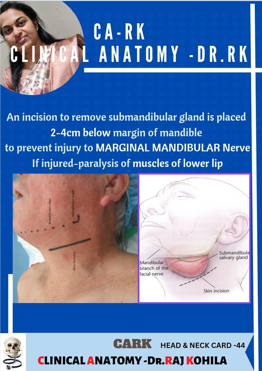 KohilaHNP's tweet photo. Surgical removal of Submandibular gland-nerve to be preserved during skin incision
#AnatEd #MedEd #Medtwitter #anatomy #sciencetwitter #AcademicTwitter #NEETPG2023 #Neetpg #usmle #fmg #plab #mrcs #anatomybody #medicalstudent #medicaleducation #mcq #imagebased #FOAmed https://t.co/qiCC2Cw5AM