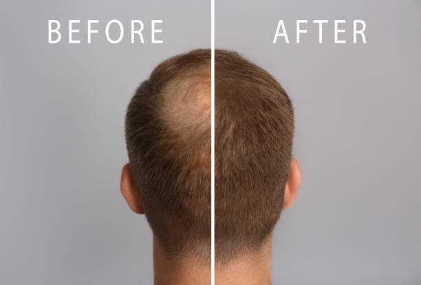 Losing hair or thinning hair can make you feel self-conscious and unattractive, there are several successful ways to treat this.

Let us diagnose and use one of our many treatments to treat this condition with our state-of-the-art medical equipment. 

#hairloss #thinninghair