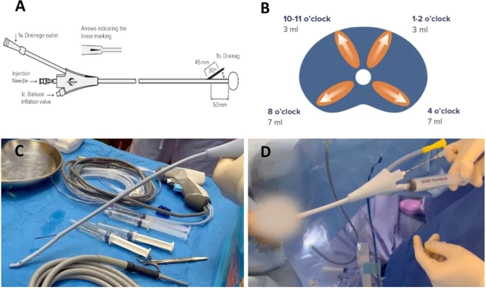 Prostate Cancer and Prostatic Diseases (@pcan_journal) on Twitter photo Find out more on the Schelin Catheter for analgesia during Rezum: rdcu.be/c5YCV
<a href="/lucacindolo/">Luca Cindolo</a> <a href="/bsc_urology/">Boston Scientific Urology</a> @BSCEMEA_UroPH
#anagesia #Practice Find out more on the Schelin Catheter for analgesia during Rezum: rdcu.be/c5YCV
<a href="/lucacindolo/">Luca Cindolo</a> <a href="/bsc_urology/">Boston Scientific Urology</a> @BSCEMEA_UroPH
#anagesia #Practice