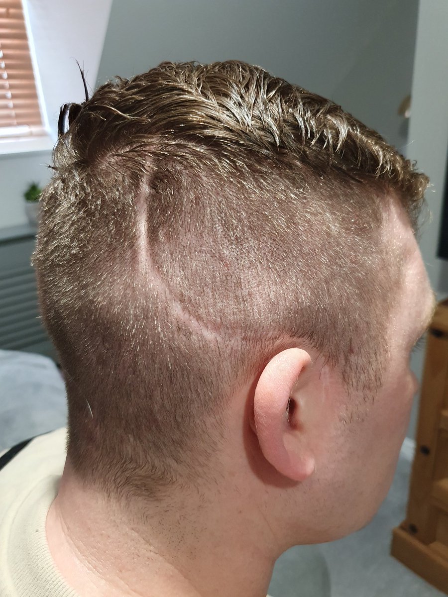 Brain Injurys don't just leave Scars on the outside they leave the Mental Health Scars. When I had to learn to Walk,Talk &amp; Eat again and worst of all no more Boxing or Driving it takes alot to recovery mentally/physically.Your whole life has to change💙 #braininjury #TrendingNow