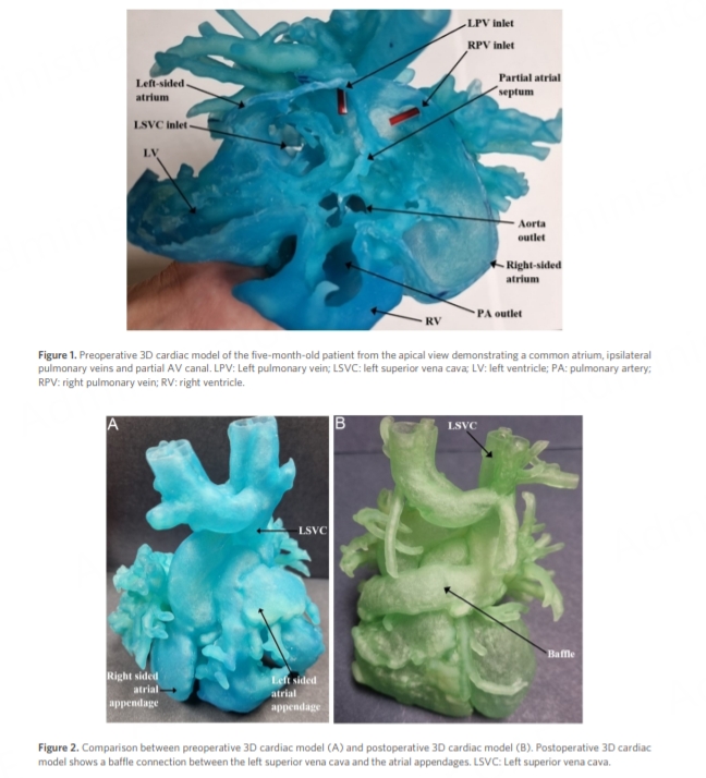 Vessel_Plus's tweet photo. 🎯#3dprint in congenital heart #surgery
Review from @bcmhouston investigates the current applications of #3dprinting , #VR, and #AR in surgery, and looks further into its role in congenital heart surgery. #3dprintmed
💠Read the full article here: https://t.co/i4m159puFY https://t.co/WunD9hgu8i