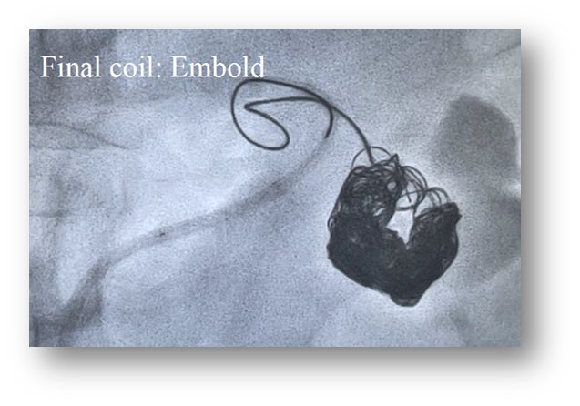 bsc_io_e's tweet photo. Excited to share the 1st EMBOLD cases in Japan were successfully completed by Dr. Masanori Inoue. #EMBOLDcoils performed in this high-flow Renal AVF. #Embolization was performed under flow control using a balloon. #MadebyIRsforIRs #irad https://t.co/t4Yx2r3TR1