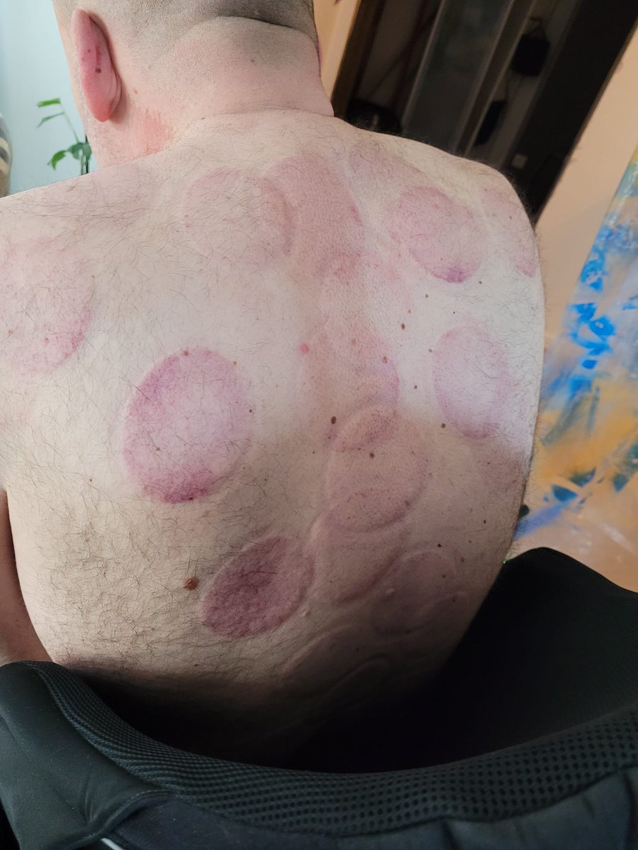 p_quintessence's tweet photo. Ik werd onder handen genomen door een sjinees
#acupunctuur
#cupping
#chinesetherapy https://t.co/tUfjoqDXH1