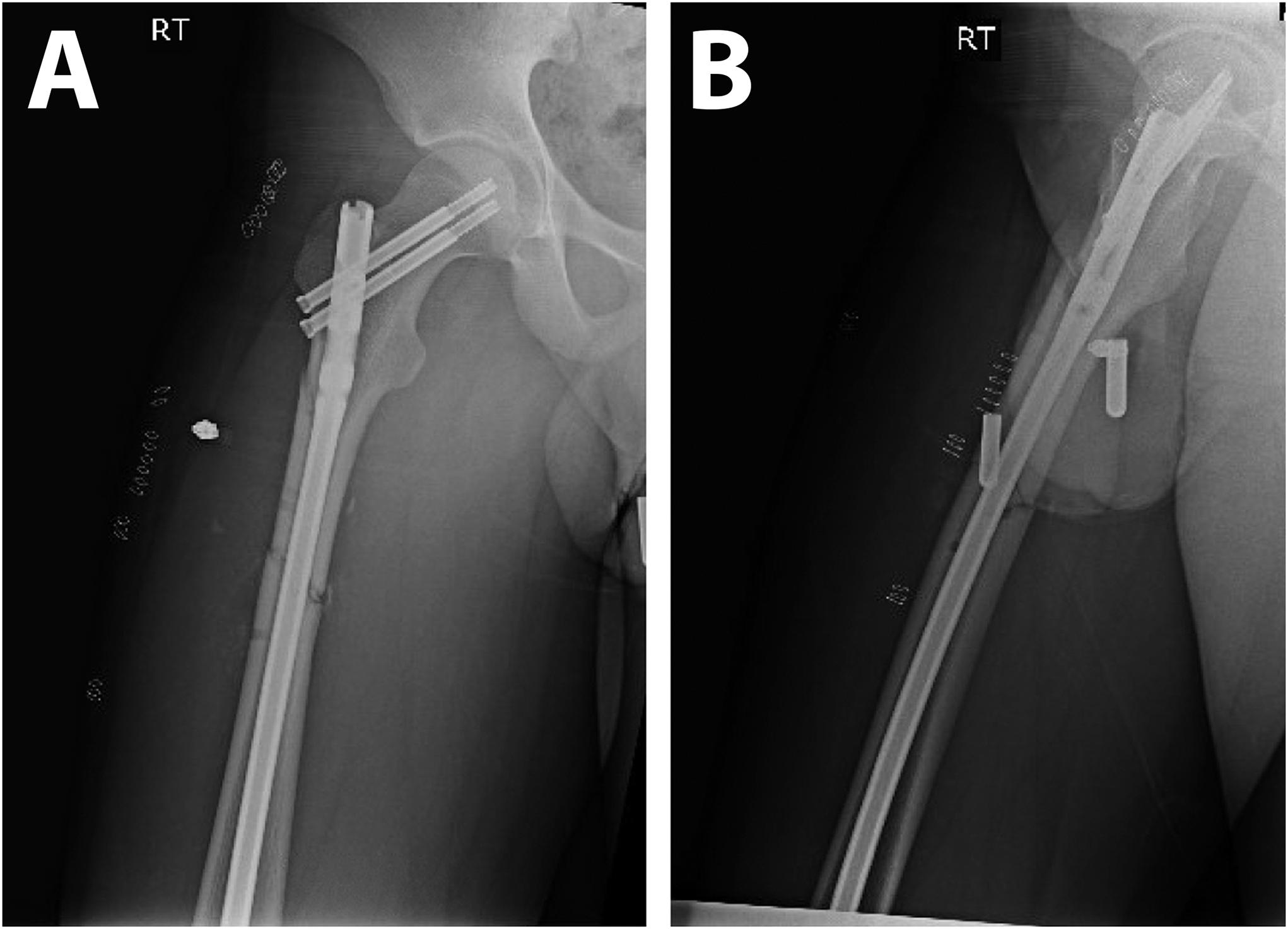 Lengthening of the Humerus Using a Motorized Lengthening Nail: A  Retrospective Comparative Series