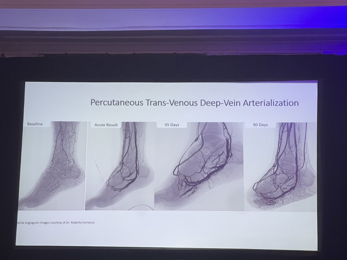 Fantastic talk about Deep Vein Arterialization by Dr. Dua at #CRT2023! <a href="/AnahitaDua/">Anahita Dua MD MS MBA FACS</a>! <a href="/MGHVascular/">Mass General Vascular</a>