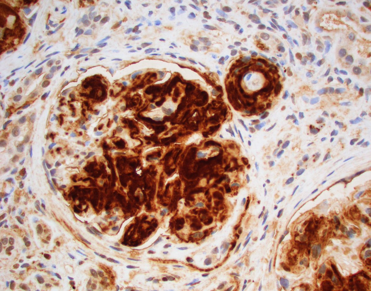 JZRenalPath's tweet image. So much amyloid! This one read the textbook. Negative silver stain. Strong congo red +. Amyloid A IHC positive confirmatory of type AA amyloidosis. #renalpath #nephropath