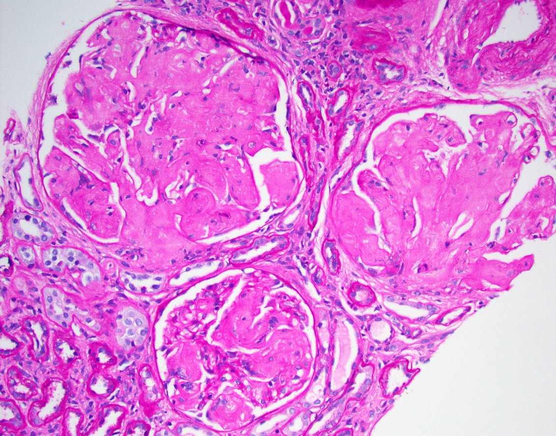 JZRenalPath's tweet image. So much amyloid! This one read the textbook. Negative silver stain. Strong congo red +. Amyloid A IHC positive confirmatory of type AA amyloidosis. #renalpath #nephropath